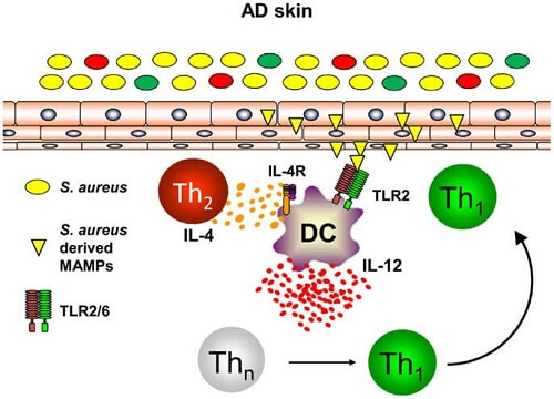 atopic-dermatitis1.jpg